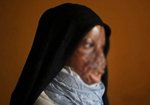 مرد سنگدل صورت همسرش را به علتی عجیب با اسید سوزاند +تصاویر