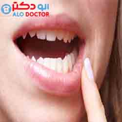 درمان خانگی زخم دهان با ۷راهکار مفید