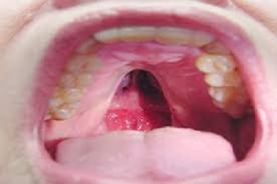سرطان به دهان هم حمله ور می شود!