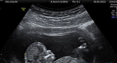 خطر سقط جنین با انجام سونوگرافی‌های بی‌‎رویه