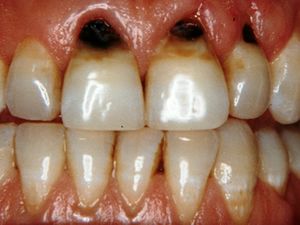 ۶ ترفند محرمانه دندانپزشکان برای جلوگیری از پوسیدگی دندان