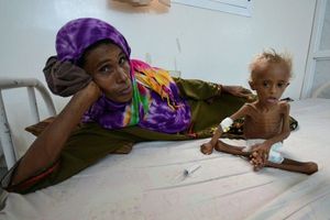 همزمان با خواندن این گزارش یک کودک یمنی از گرسنگی جان می‌دهد + تصاویر