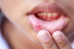 ۱۰ روش درمان خانگی آفت دهان