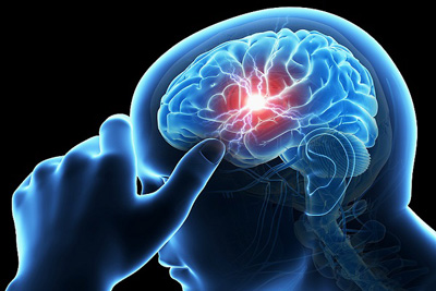 علائم هشدار دهنده سکته مغزی کدامند