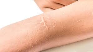 درمان جای زخم‌های کهنه پوست