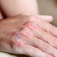 خشکی پوست نشانه چه بیماری است؟