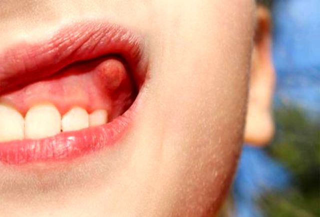 ترفند های خانگی برای درمان سریع عفونت دندان