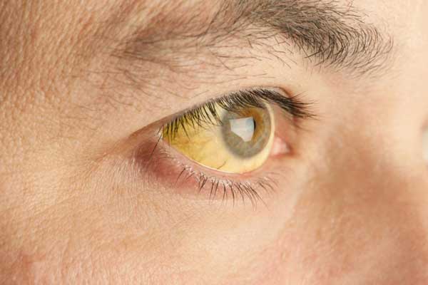 لکه زرد در چشم نشانه چیست؟
