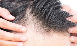 ۶ دلیل که باعث ریزش موها می‌شود